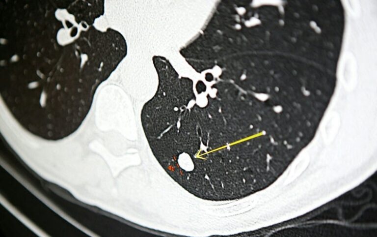 Most Folks at Threat for Lung Most cancers By no means Get Screened: Here is Learn how to Repair That