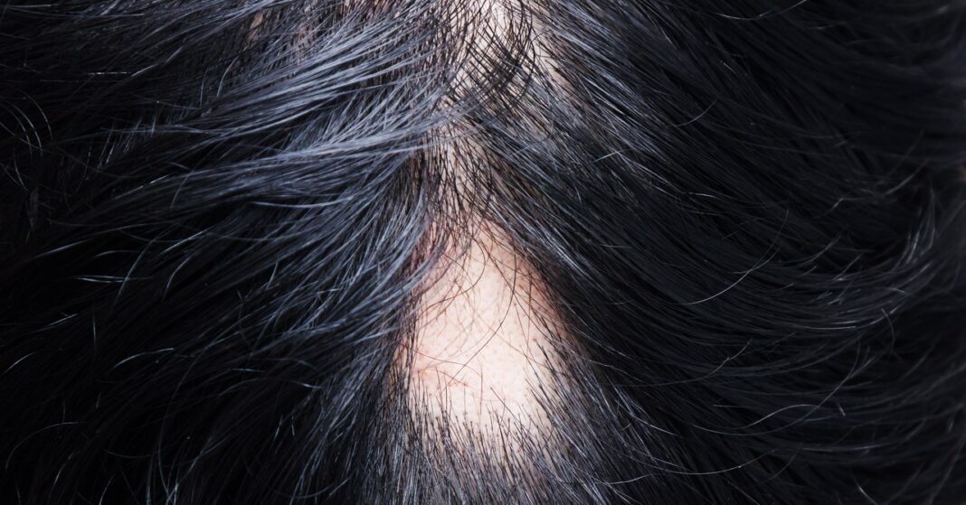 This Follicle-Hacking Drug Could One Day Treat Baldness