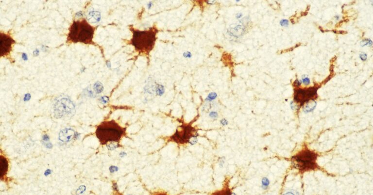 To Understand Brain Disorders, Consider the Astrocyte