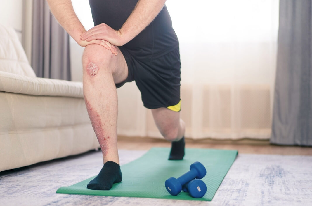 A man with psoriasis on his leg does exercises at home.