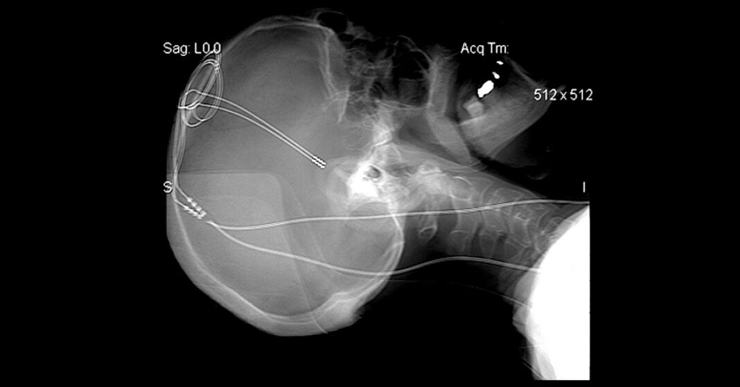 The Quest to Treat Binge-Eating and Addiction—With Brain Zaps