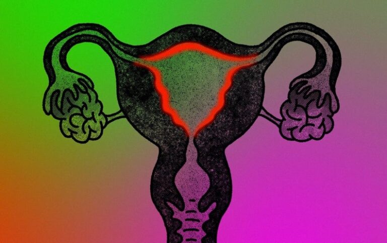 One in 10 Who Menstruate Suffer from Endometriosis. Why Do We Know So Little about It?