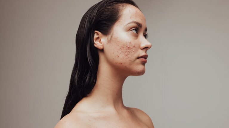 How To Treat Every Type of Adult Acne at Home: Cystic Acne, Blackheads, Acne Scars, and More