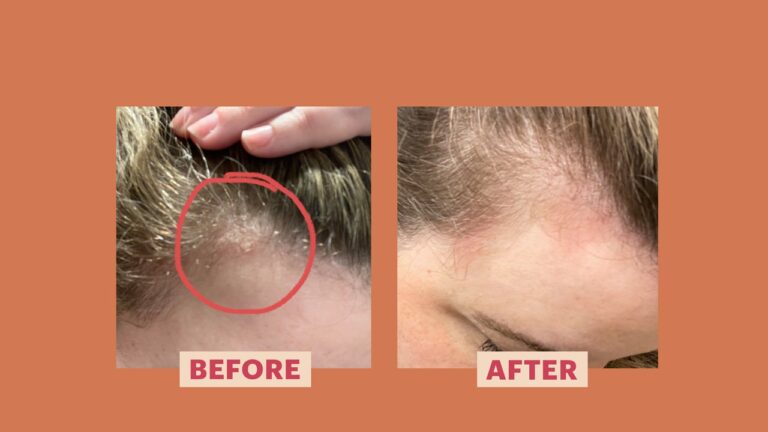 My Scalp Psoriasis Came Out of Nowhere — Here’s How I Treated It