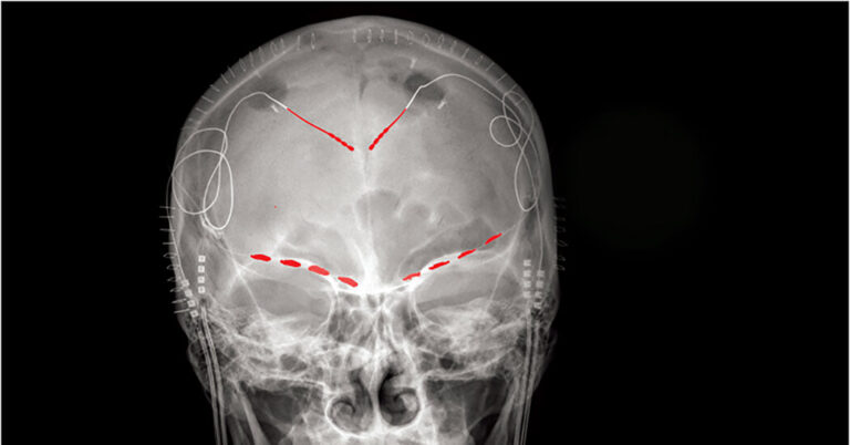 Chronic Pain Linked to Brain Signals in Orbitofrontal Cortex