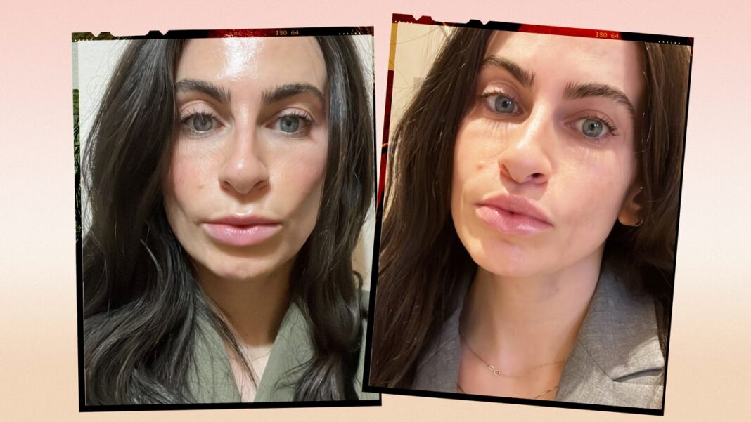 How I Really Feel About My Lip Lift Surgery — See My Before and After Photos