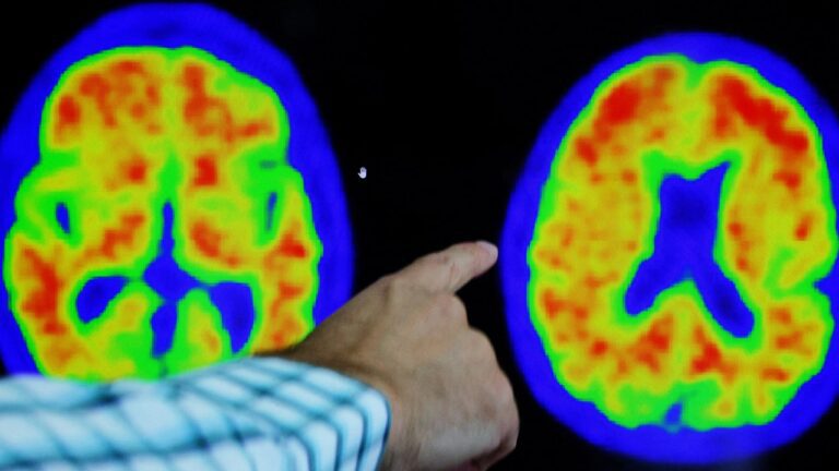 Several Alzheimer’s vaccines enter clinical trials amid breakthrough treatments’ success